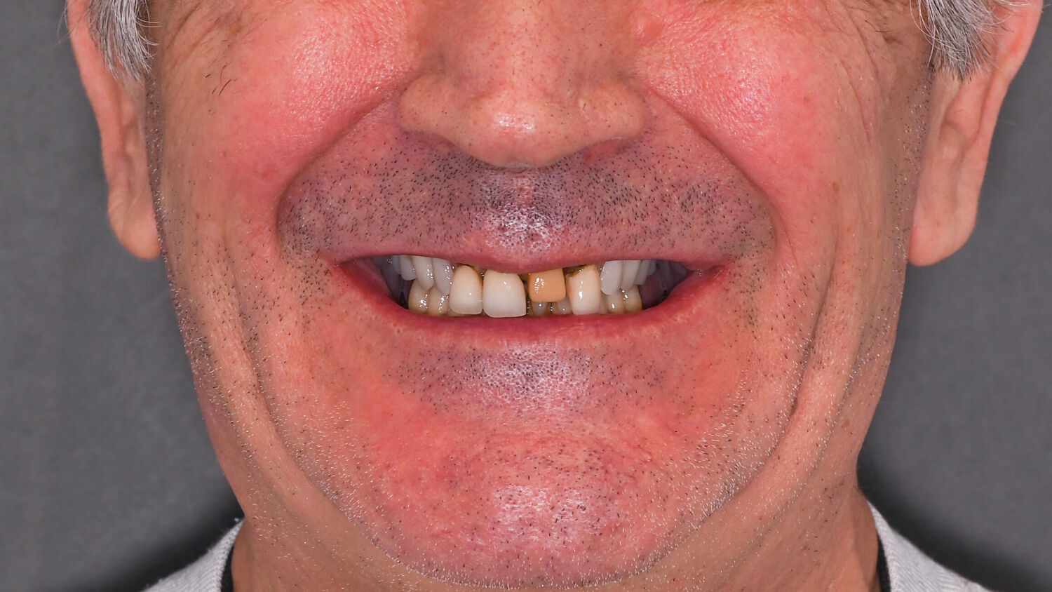 Pacient Clinica Dr. Alin Odor - Rezultat Implantologie